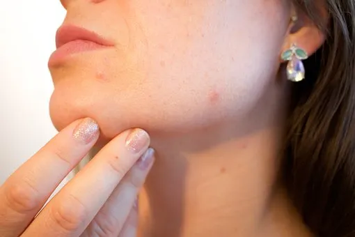 Acne Treatment Gurgaon