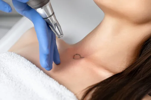 Laser Tattoo Removal Gurgaon